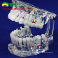 DENTAL09(12568) Human Adult Size Transparent Disease Oral Model